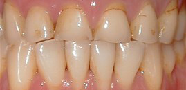 Waterford Dental Health | Implant Restorations, Veneers and All-on-4 reg 