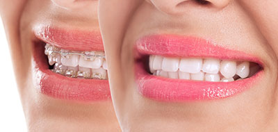 Waterford Dental Health | Digital Impressions, Inlays  amp  Onlays and Extractions