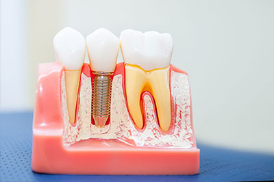 Waterford Dental Health | Veneers, Extractions and Full Mouth Reconstruction