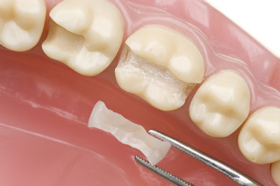 Waterford Dental Health | Inlays  amp  Onlays, Dental Sealants and Veneers
